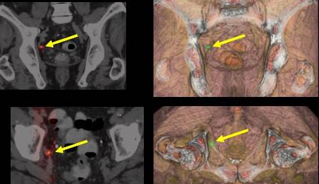 foto cabecera recidiva ganglionar del cáncer de próstata.jpg