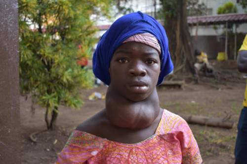 paciente tiroide sierra leona antes de ser operada