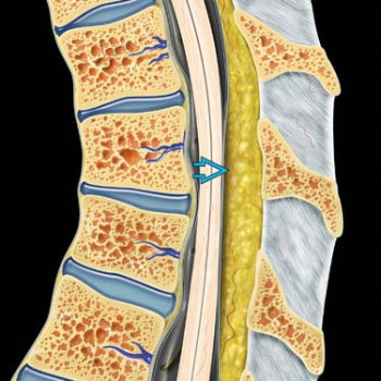 Imagen lipomatosis