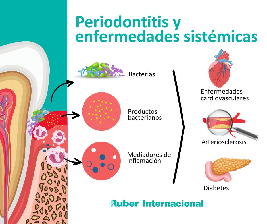 Periodontitis: una enfermedad bucal que puede afectar la salud general