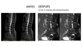 ANTES Y DESPUÉS DISCOLOSIS CON OZONO HERNIA DISCAL