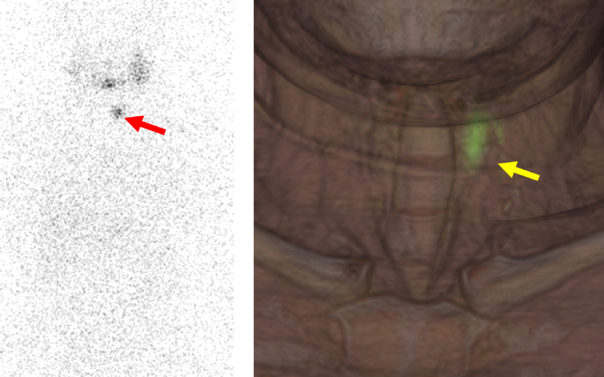 tratamiento con Iodo 131 del cáncer de tiroides