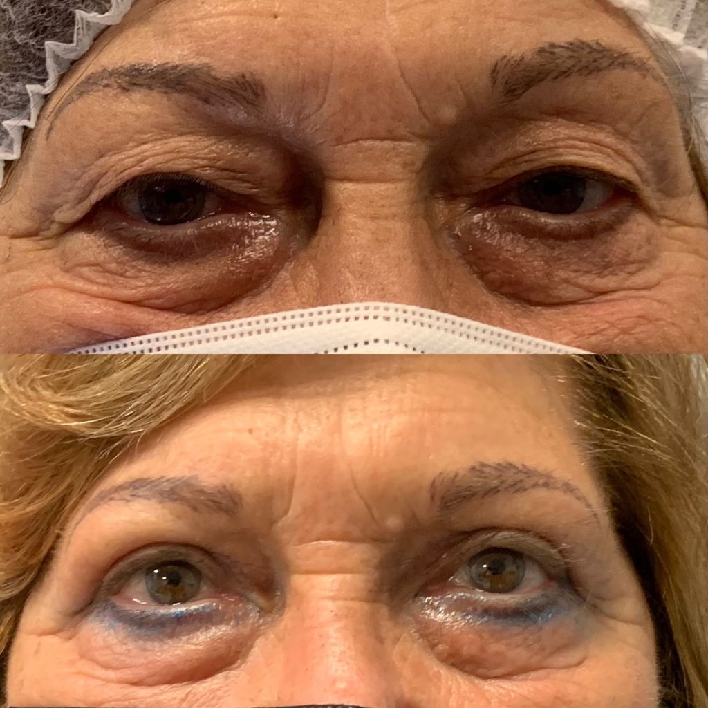 Resultado de la blefaroplastia sin cirugía ppal