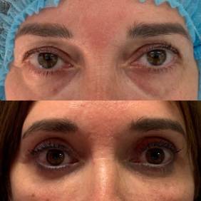 Resultado de la blefaroplastia sin cirugía 1