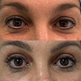 Resultado de la blefaroplastia sin cirugía 2