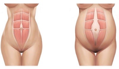 Reparación endoscópica de rectos abdominales