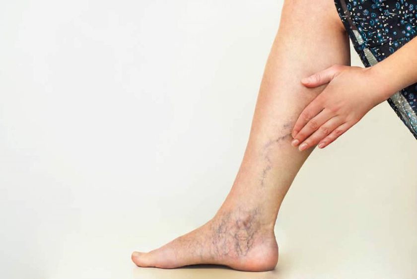 varices