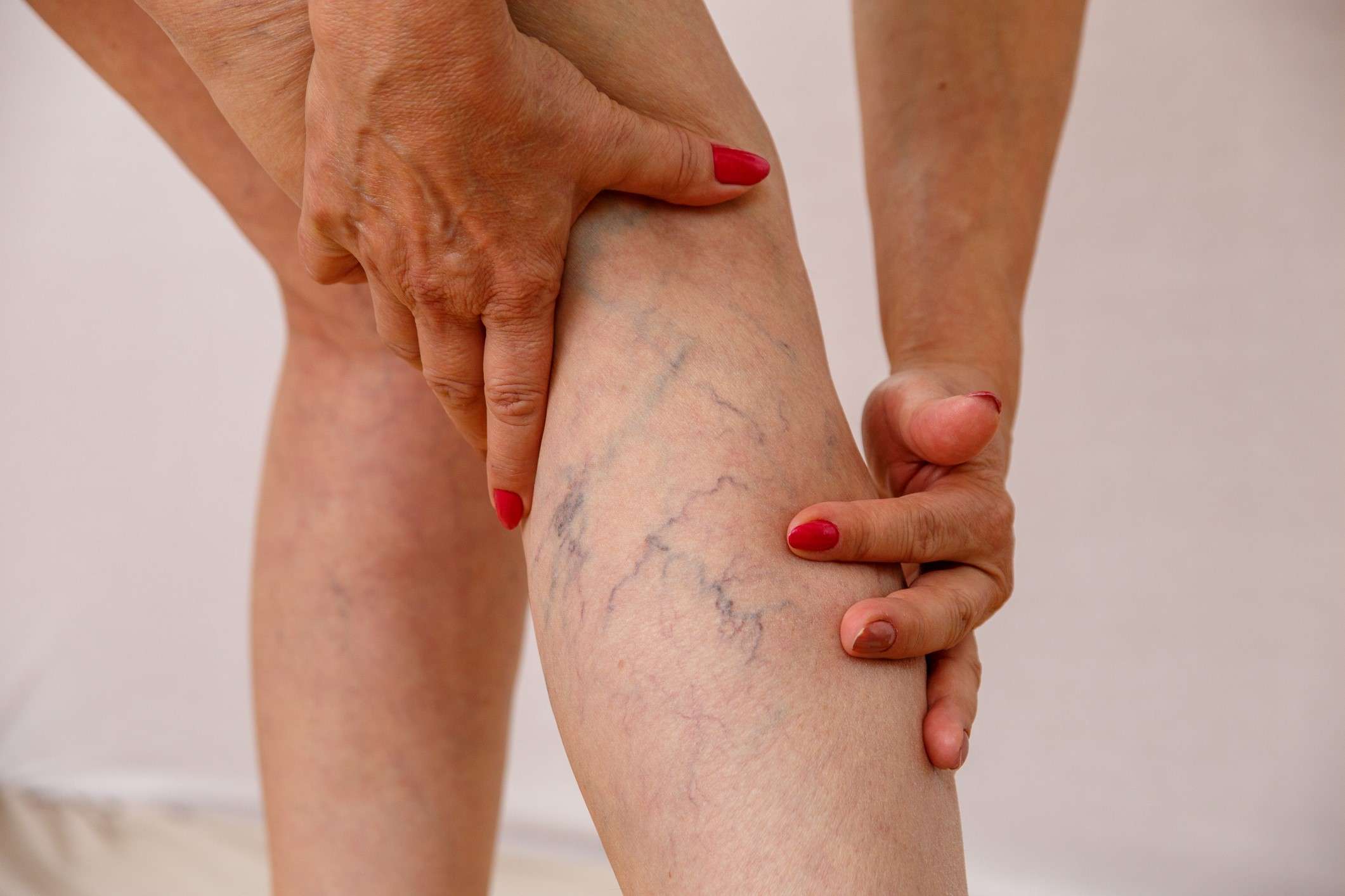 varices_1[1]