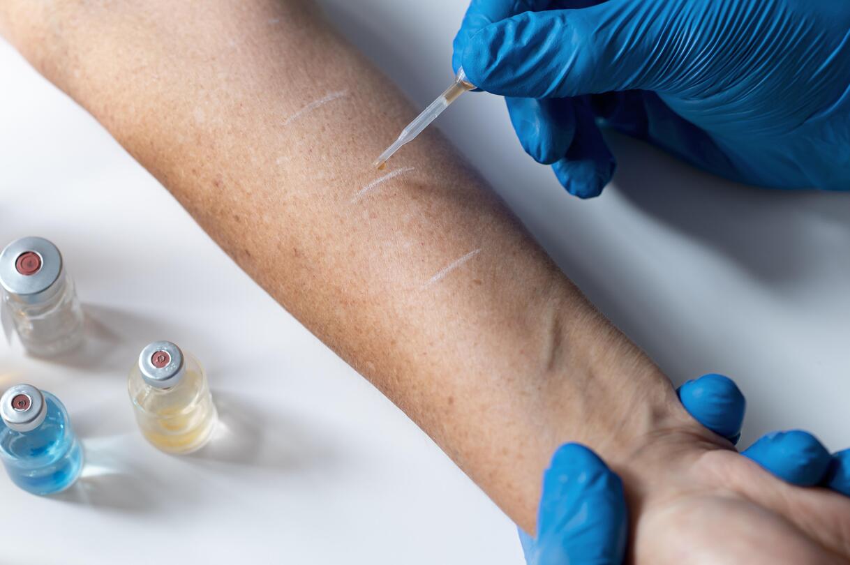 prueba-de-reaccion-alergica-cutanea-en-el-brazo (1)