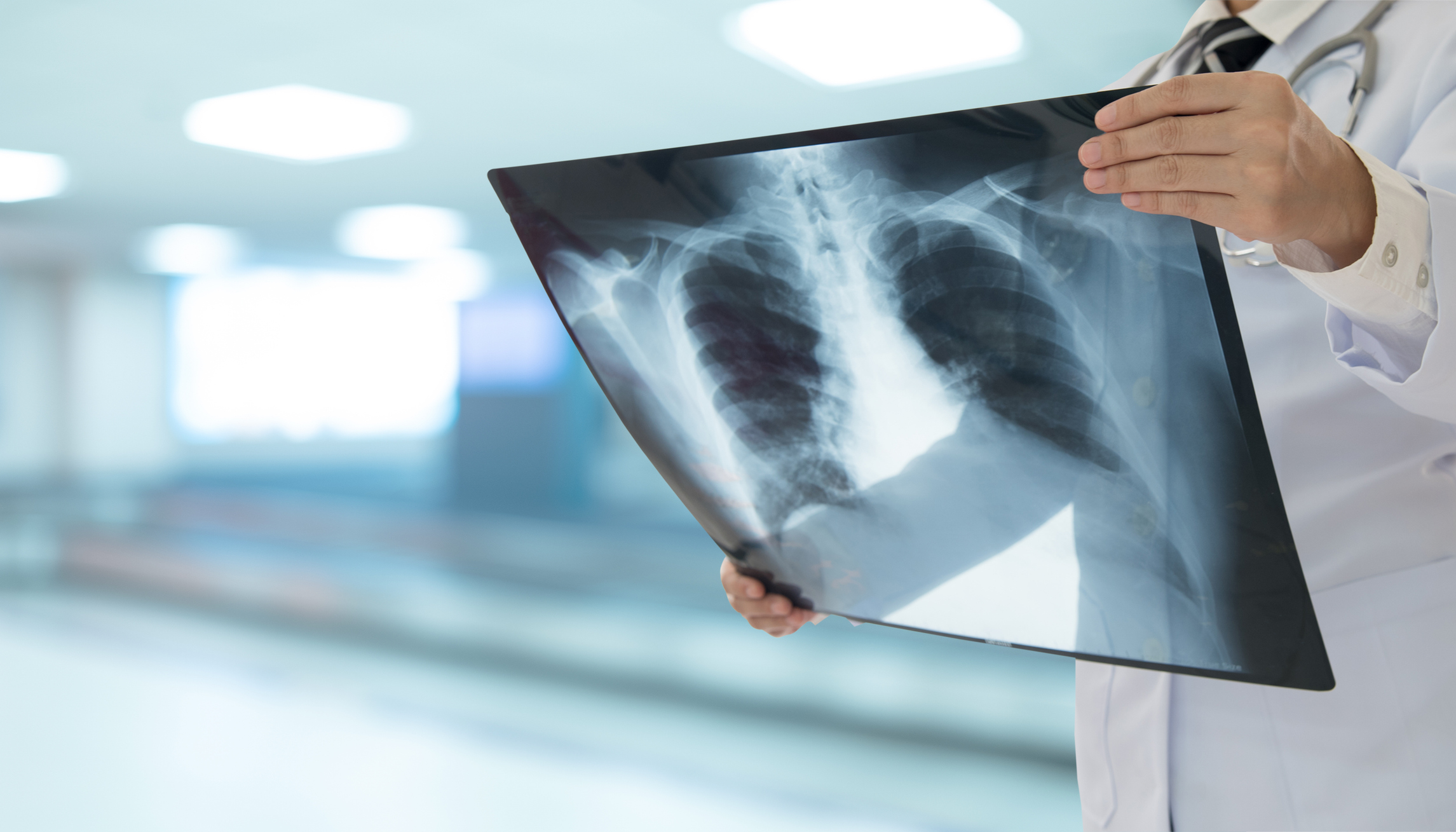 Foto cáncer de pulmón en no fumadores