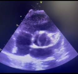 Cardiopatia
