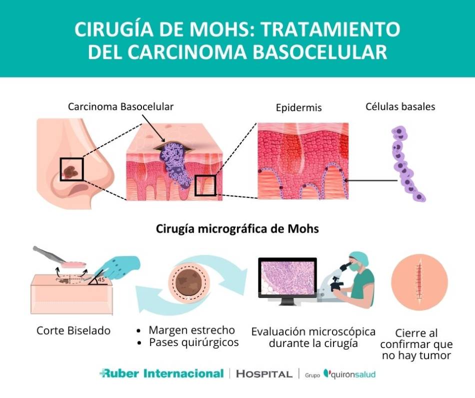 cirugía de mohs carcinoma basocelular tratamiento