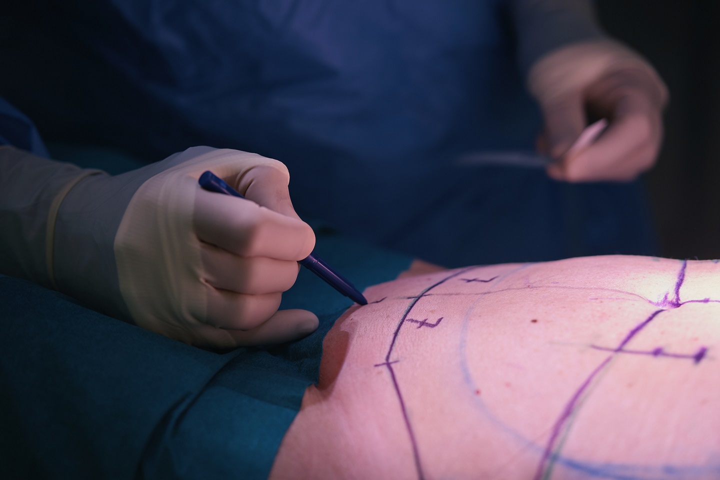abdominoplastia