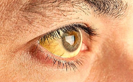 ojos-amarillos-ictericia