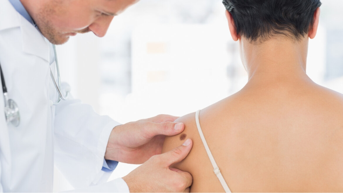 detectar-prevenir-cancer-piel