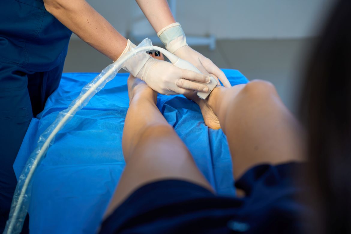 Varices