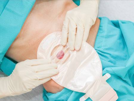 Foto cabecera Ostomía