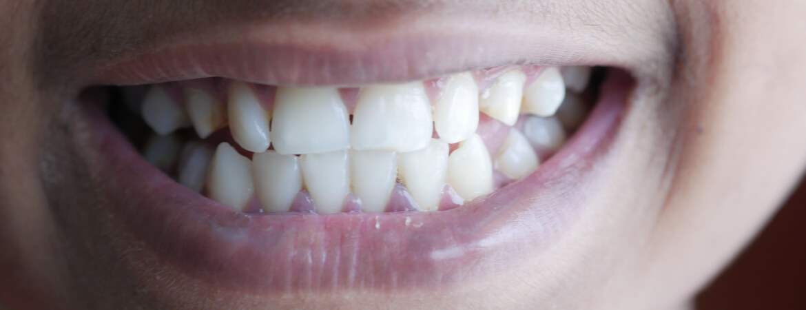 implantes-cortos-pacientos-poco-hueso