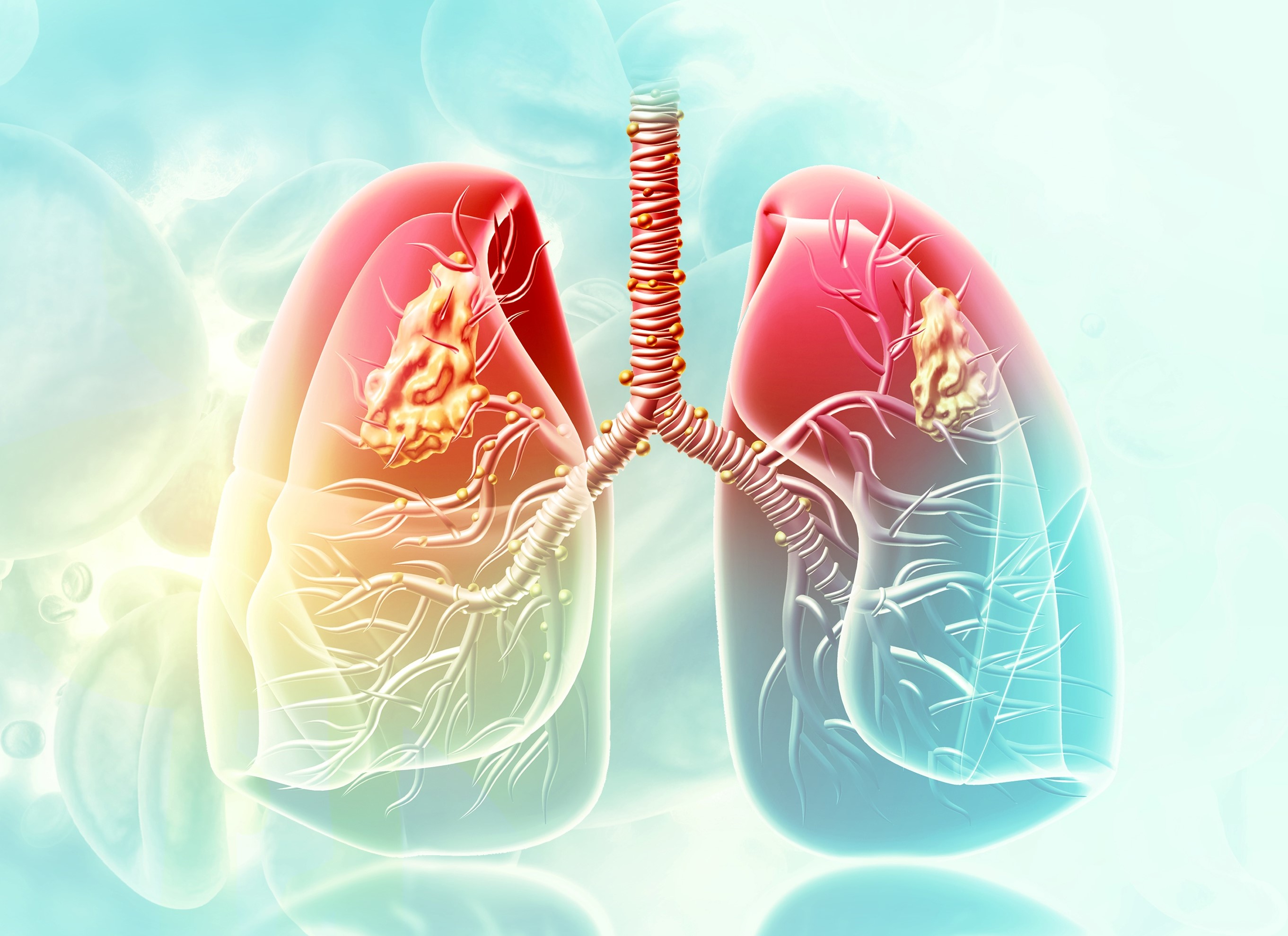 Cáncer de pulmón