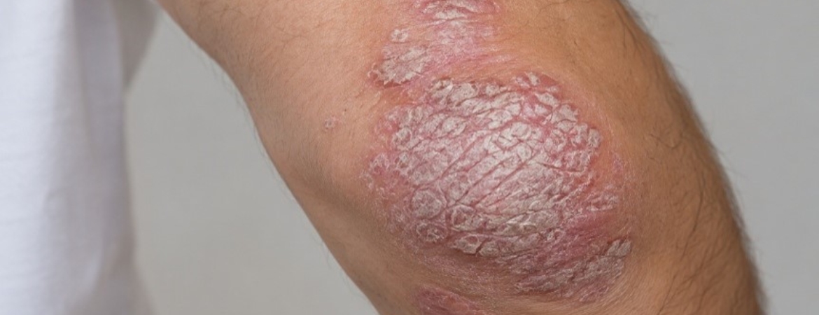 psoriasis-claves-entender-controlar-enfermedad-piel