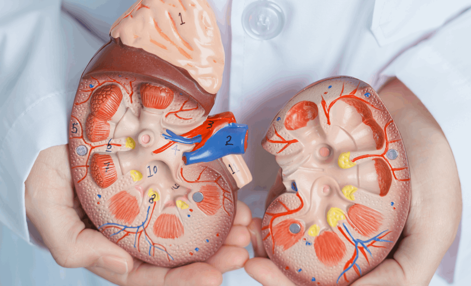Litiasis Renal