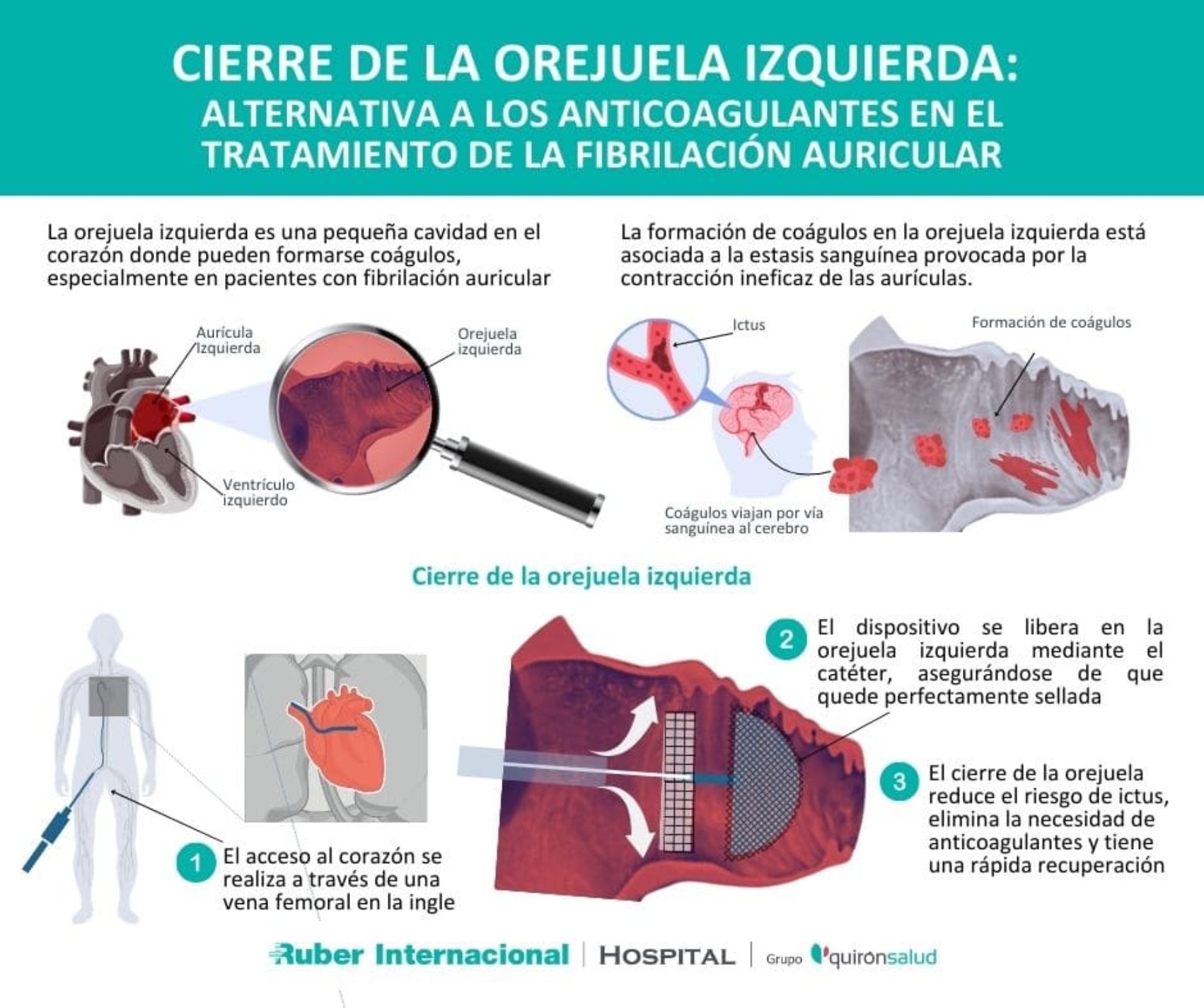 Tratamiento de la Fibrilación Auricular: Cierre de la orejuela ...