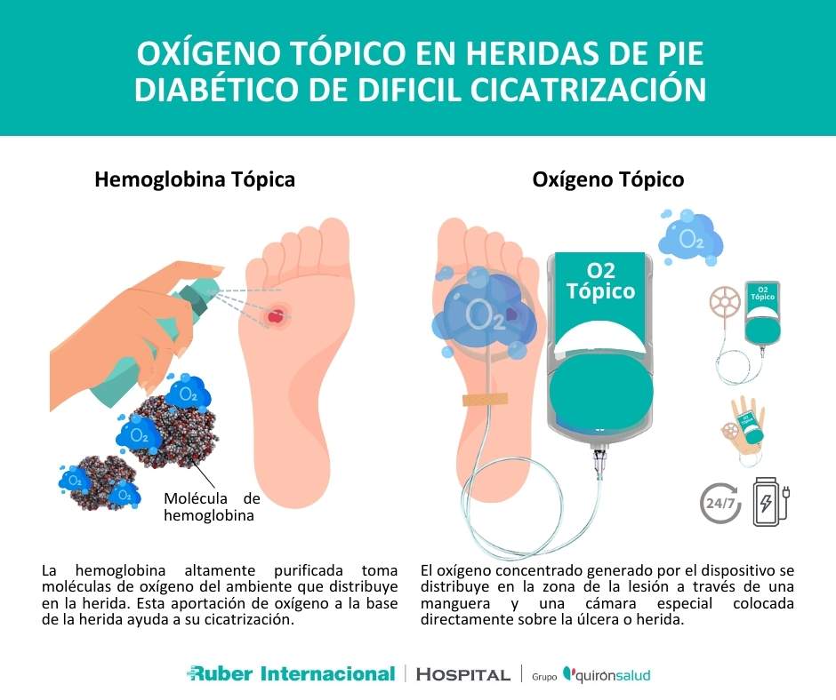 oxigeno topico y hemoglobina spray granulox en herida pie diabetico cicatrizacion