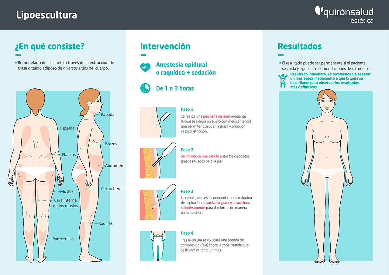 Infografía de Lipoescultura