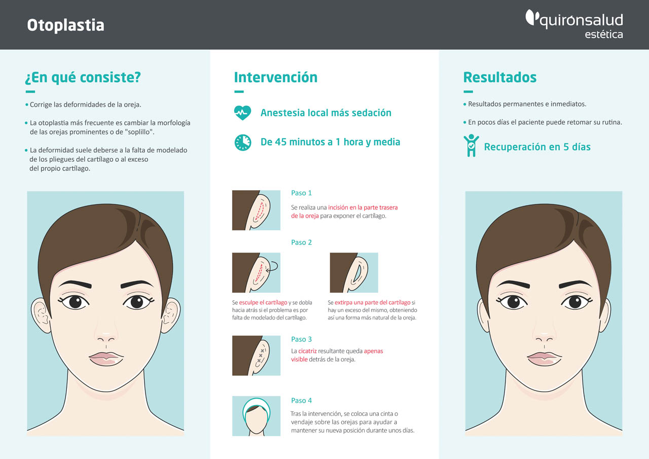 Infografía Otoplastia