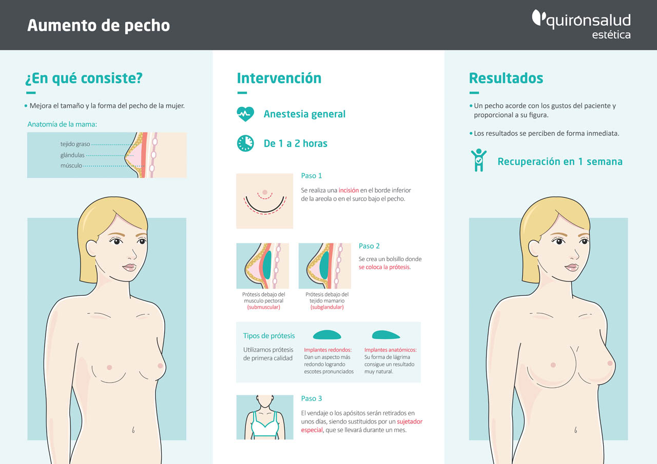 Infografía Aumento de pecho