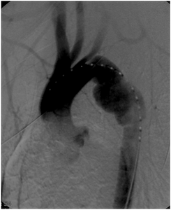 Rotura traumàtica de la aorta toràcica: seudoaneurisma aórtico