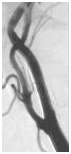 Resultado tras la colocación del stent carotídeo