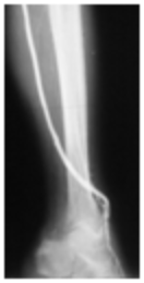 Imagen de arteriografía que muestra bypass con vena safena a arteria tibial anterior.
