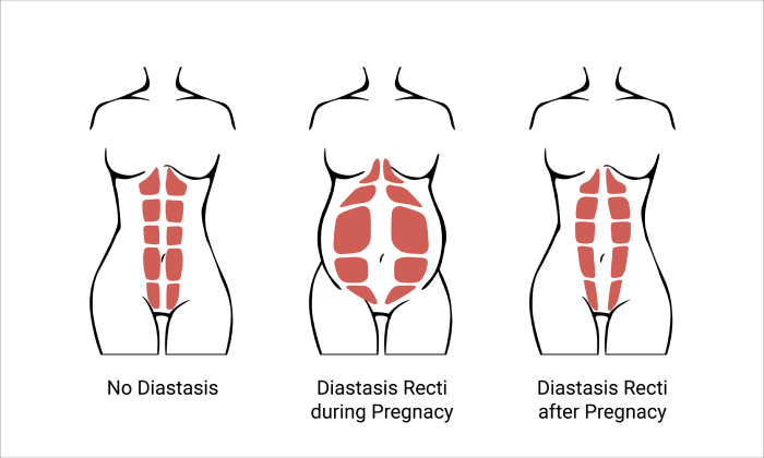 Pared abdominal