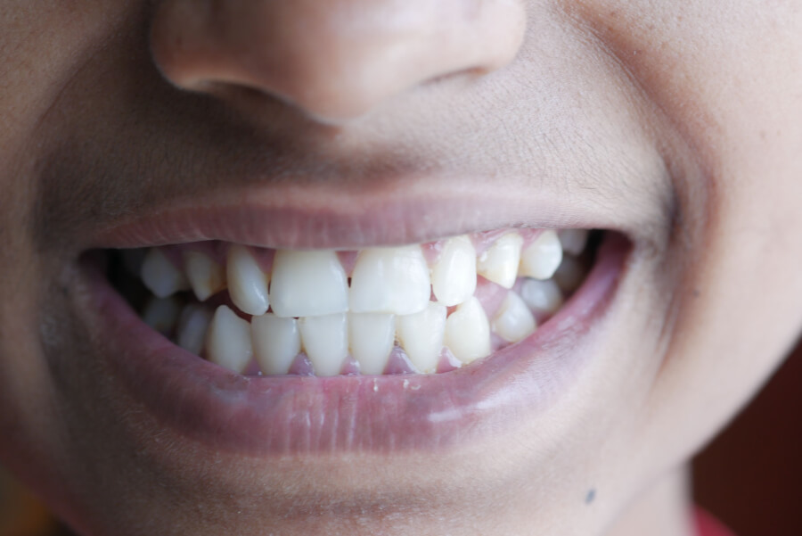 sonrisa-implantes-cortos