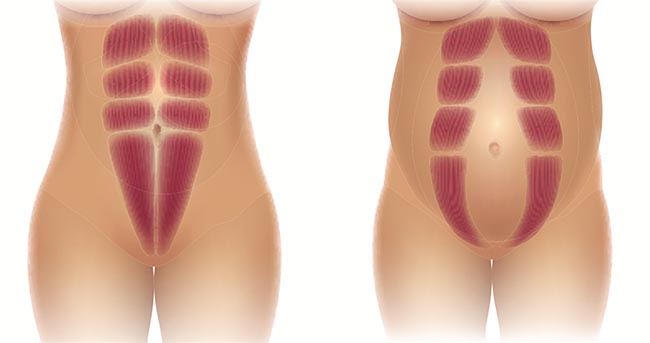 Diastasis