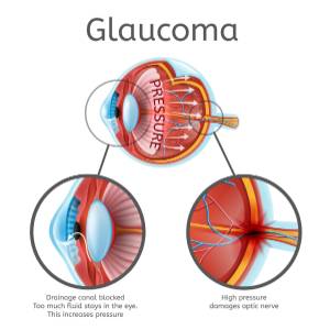 Glaucoma 2