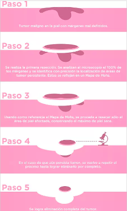 Pasos cirugía micrográfica de Mohs