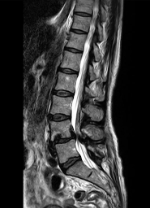 Estenosis canal lumbar