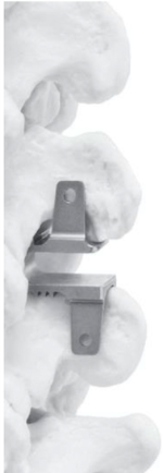 Dispositivo interespinoso de forma cónica