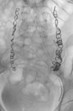 embolización realizada en ambas venga ováricas mediante colisa