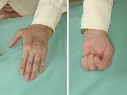 Flexión y extensión mano izquierda operada