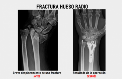 Antes y después fractura radio
