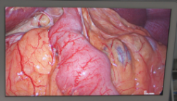 En el monitor se aprecia el realce de la vascularización