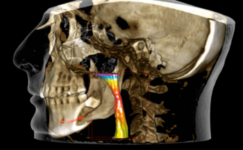 Estudio de via aerea para paci entes con apnea del sueño 2