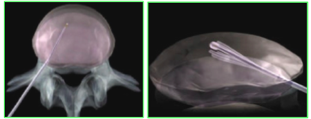 La nucleoplastia es un tratamiento alternativo a la cirugía