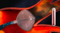 Balón oclusor de crioablación utilizado para realizar la ablación de fibrilación auricular.