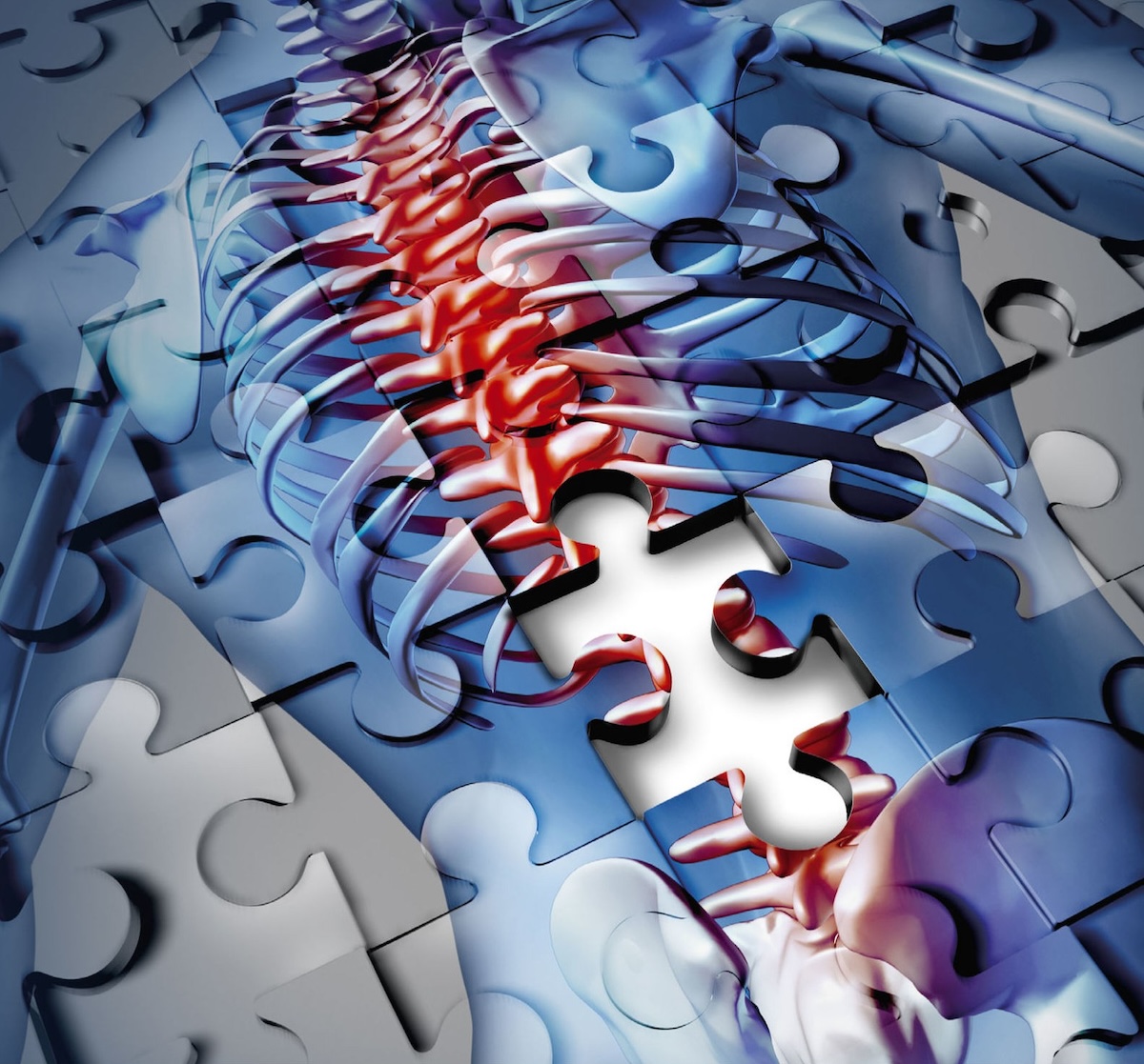 Estenosis de canal lumbar