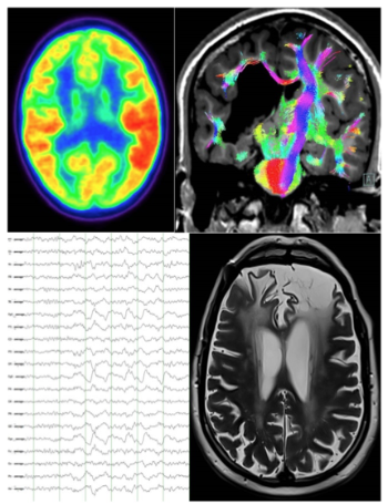 Epilepsia