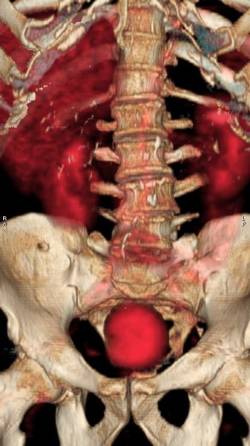 Espondilodiscitis lumbar en paciente con cuadro de dolor no localizado. PET-TAC detecta infección a nivel vertebral.